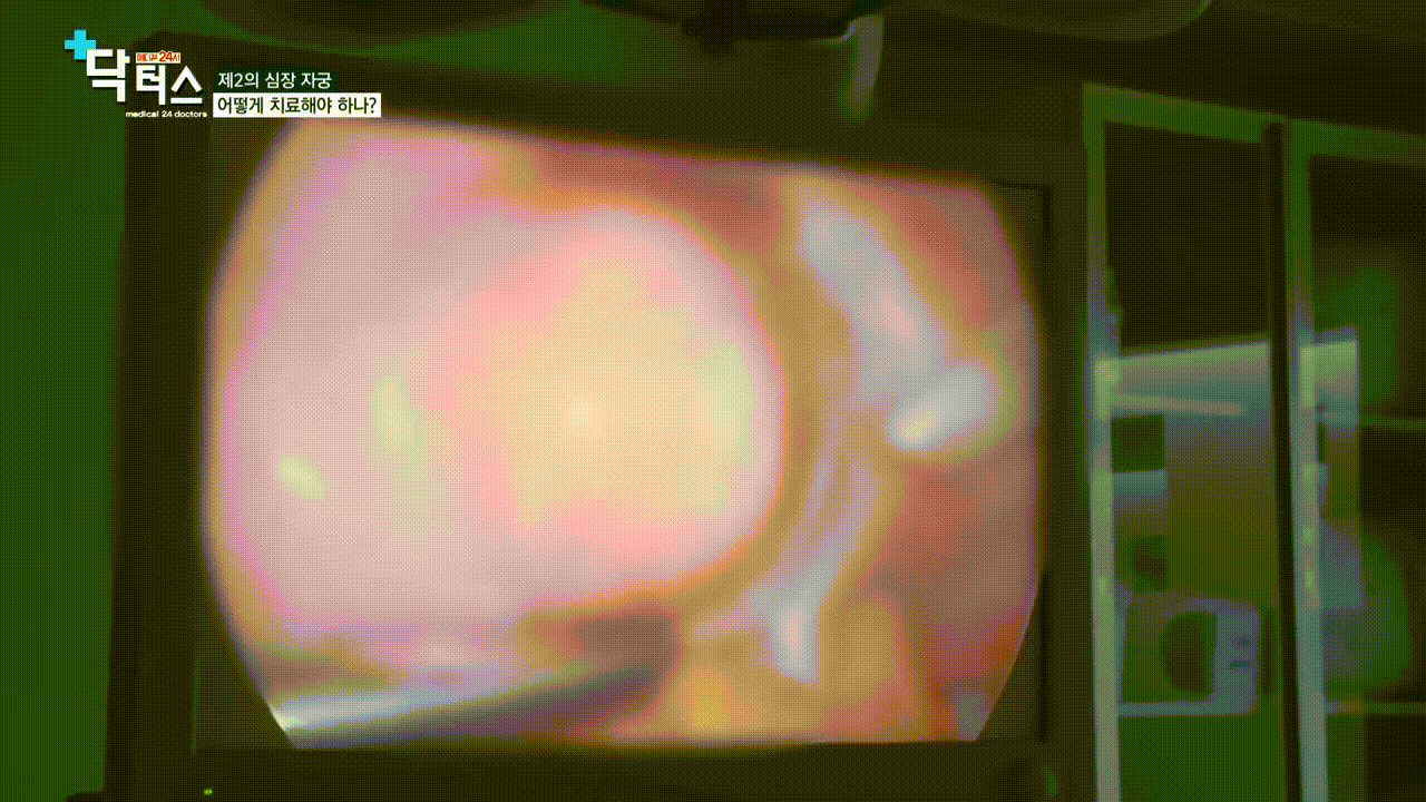 자궁근종 수술