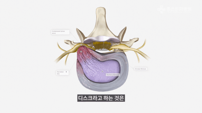 허리디스크 발생 원인 : 디스크 탈출