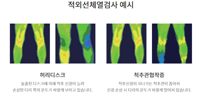 적외선체열검사