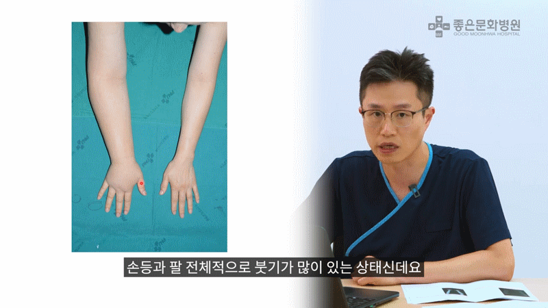 ICG 검사를 통해 기능하고 있는 림프관 확인