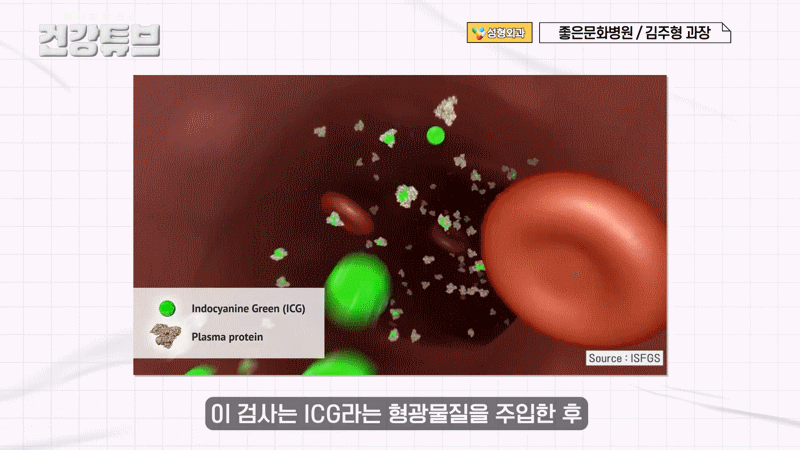 ICG 조영술