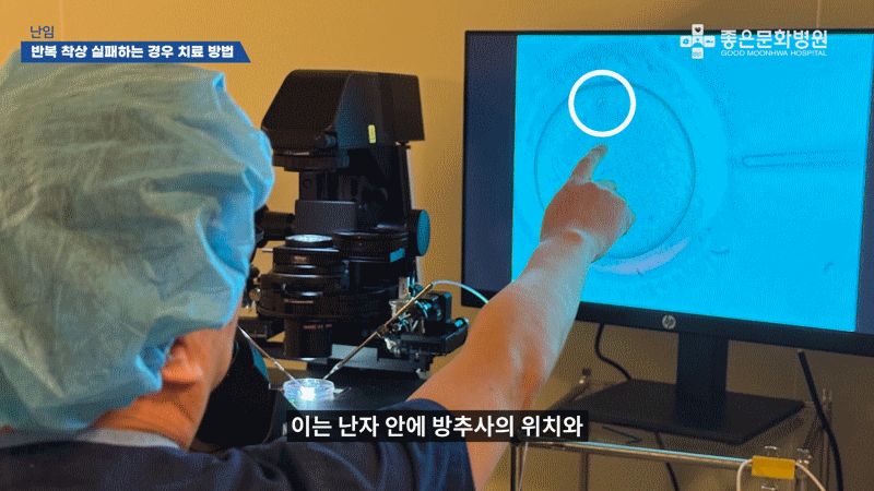 난임 시술 성공률 높이는 방법 : 편광현미경